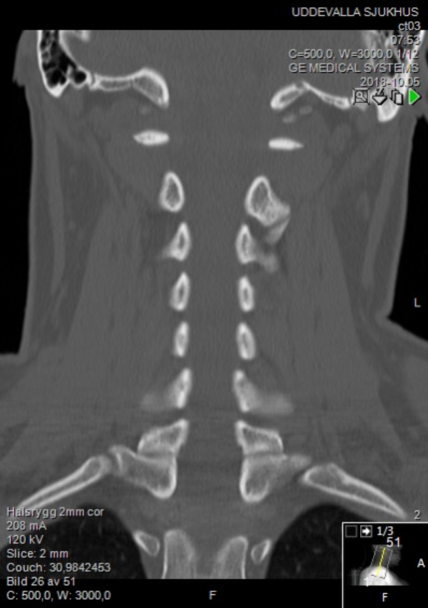 Eine MRT-Aufnahme eines Mannes mit einem sichtbaren Bruch, auf einem Computerbildschirm angezeigt.