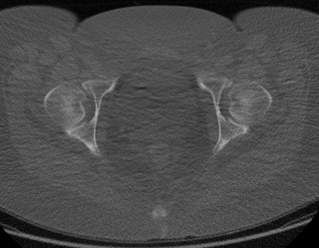 Eine Schwarz-Weiß-MRI-Aufnahme des Abdomens eines Mannes, die sich auf die Prostata konzentriert und detaillierte anatomische Strukturen zeigt.