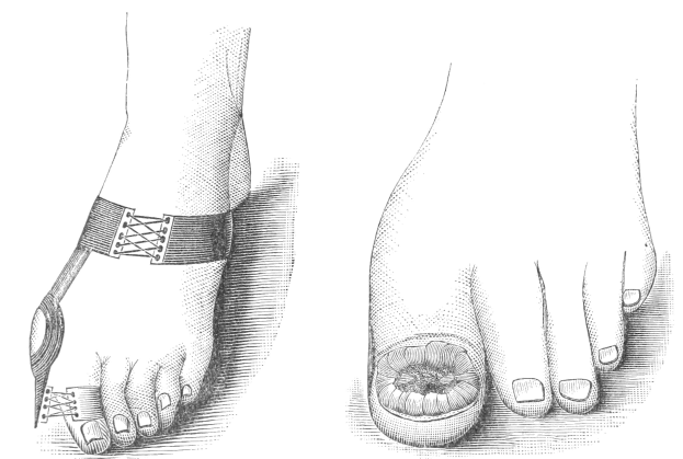 Schwarze und weiße Zeichnung eines Paares Füße, einer mit einem Verband und der andere mit einer Fraktur, mit Text unten, der die Behandlung angibt.